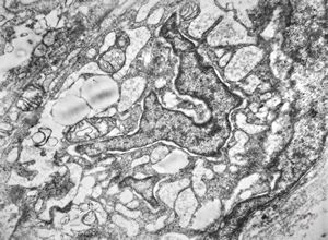 F,12y. | liposarcoma v.s.- orbita F,12y. | liposarcoma v.s.- orbita